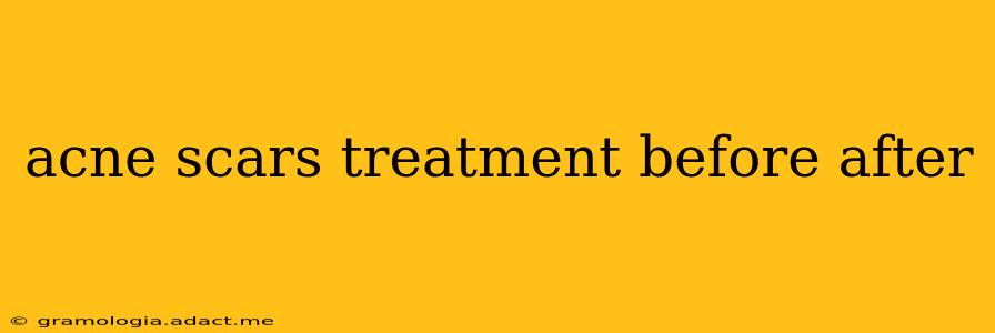 acne scars treatment before after