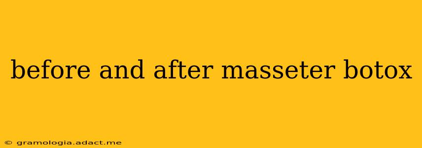 before and after masseter botox