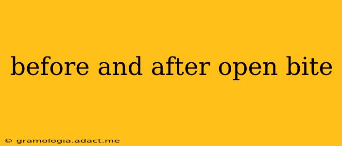 before and after open bite