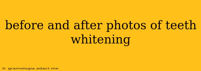 before and after photos of teeth whitening
