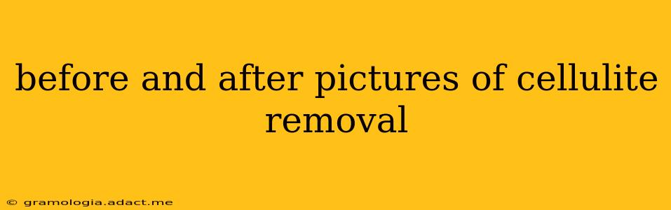before and after pictures of cellulite removal