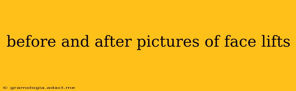 before and after pictures of face lifts