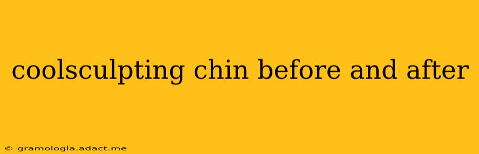coolsculpting chin before and after