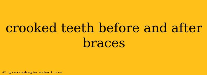 crooked teeth before and after braces
