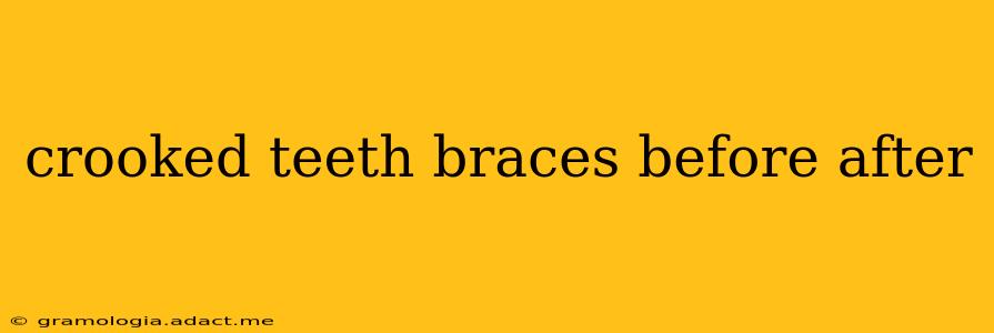 crooked teeth braces before after