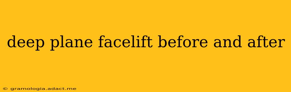 deep plane facelift before and after