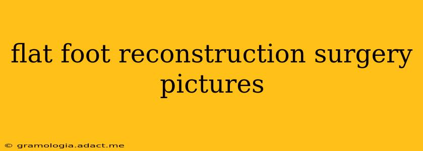 flat foot reconstruction surgery pictures