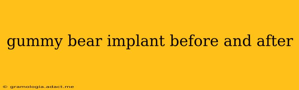 gummy bear implant before and after