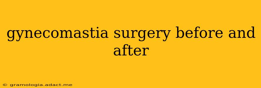 gynecomastia surgery before and after
