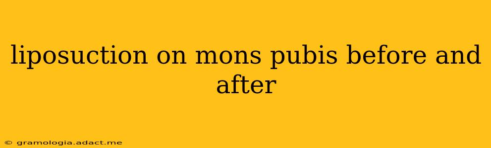 liposuction on mons pubis before and after