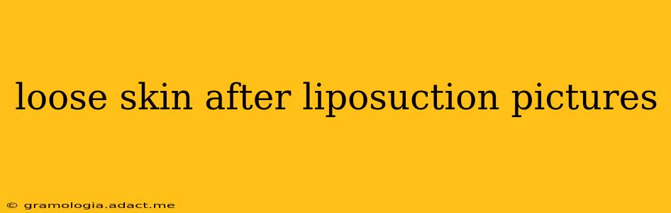 loose skin after liposuction pictures