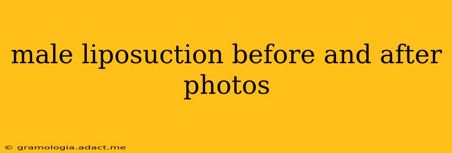 male liposuction before and after photos