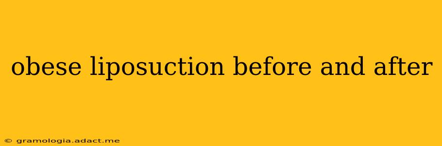 obese liposuction before and after