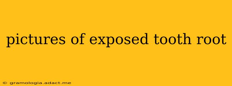 pictures of exposed tooth root