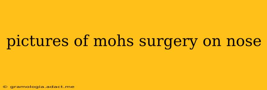 pictures of mohs surgery on nose