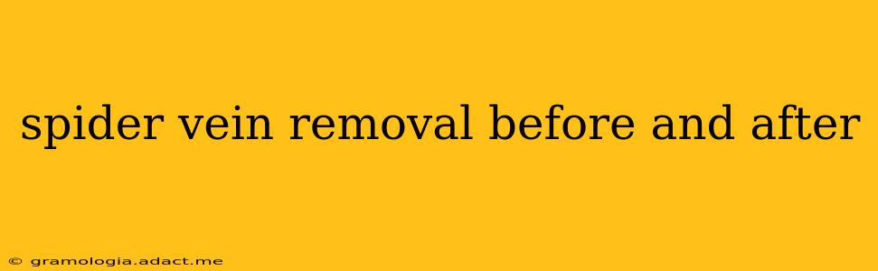 spider vein removal before and after