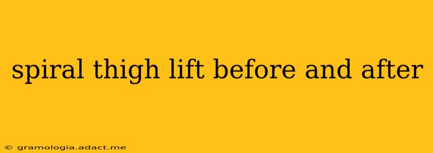 spiral thigh lift before and after