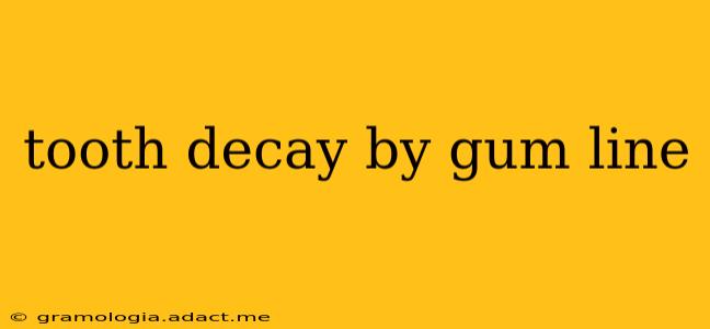 tooth decay by gum line