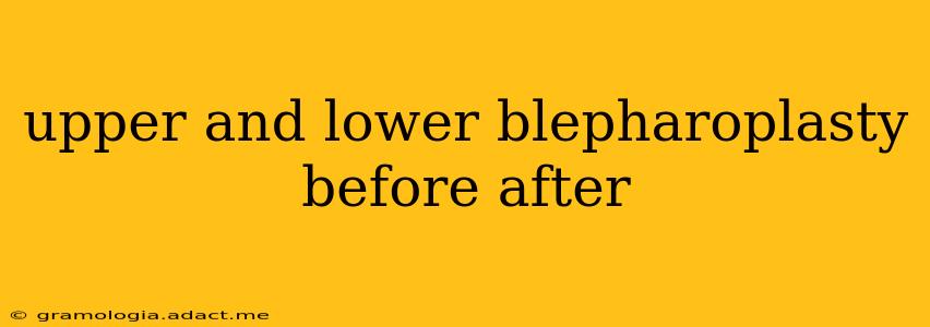 upper and lower blepharoplasty before after