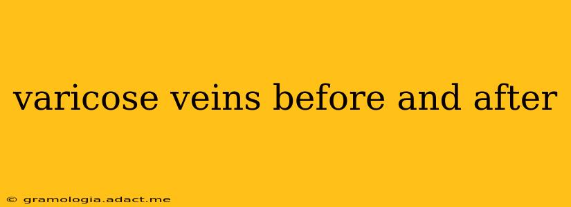 varicose veins before and after