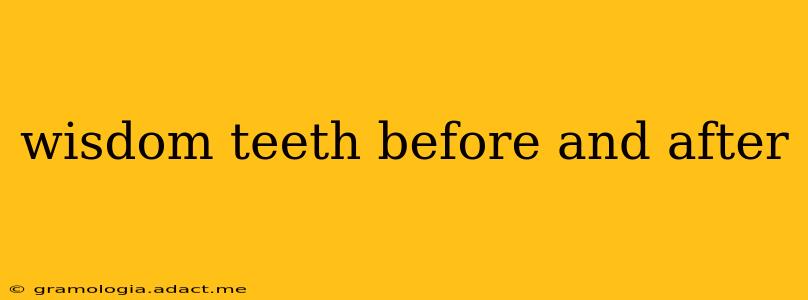 wisdom teeth before and after