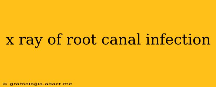 x ray of root canal infection
